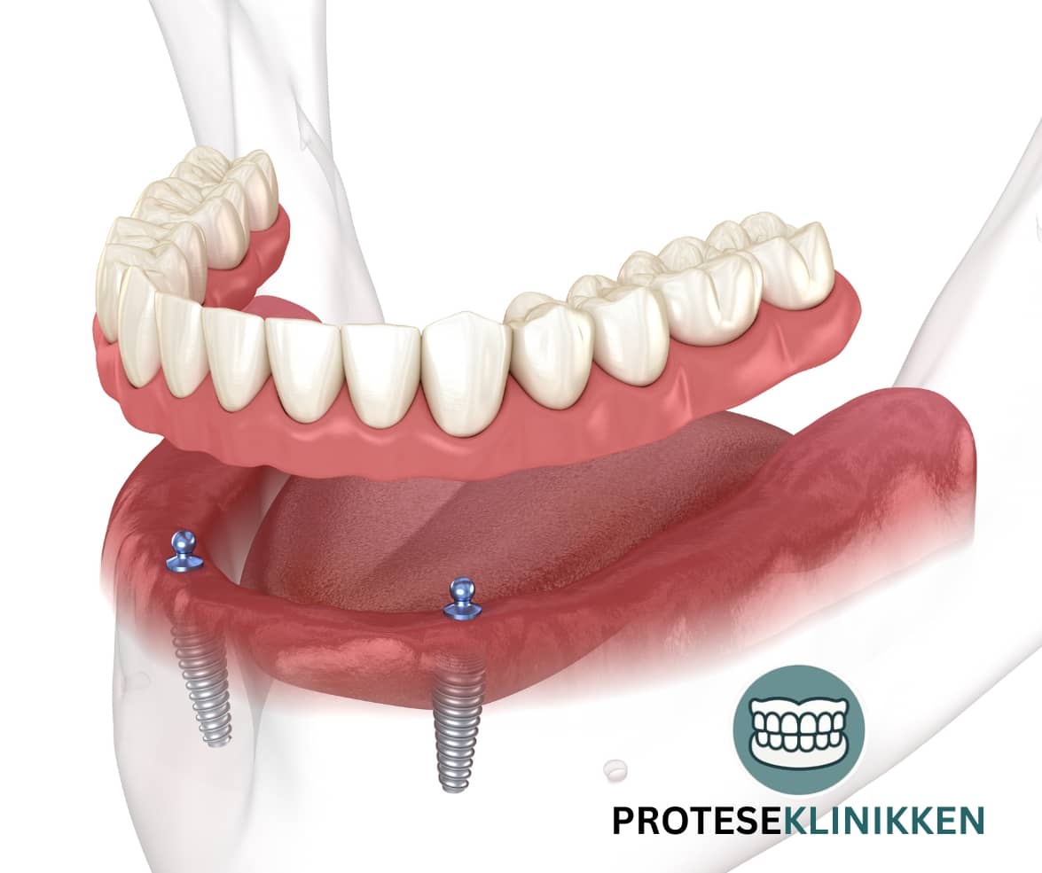 Tannprotese med klikk-system for 2 implantat