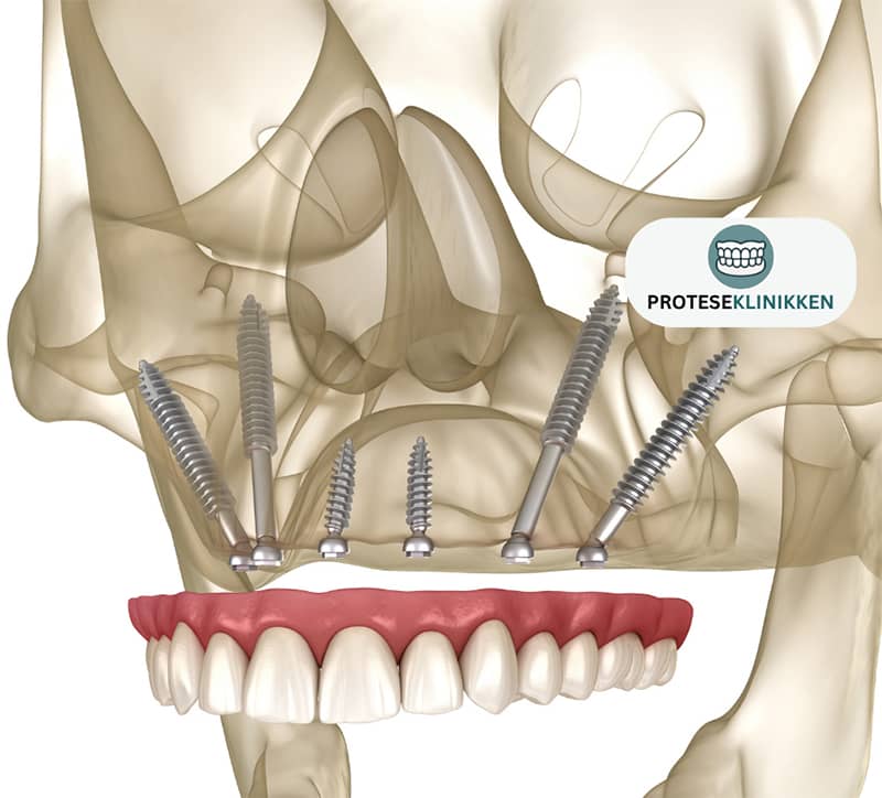 Zygoma kinnbenimplantat